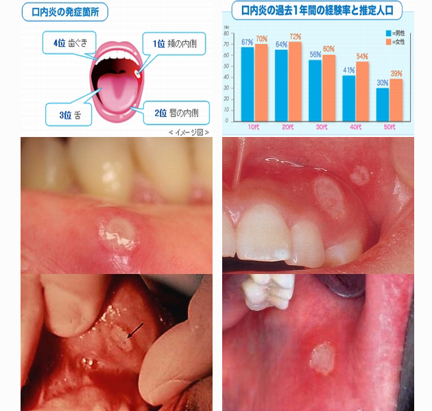 治し 口内炎 方 白い 口内炎が白い場合に注意すべき特徴とは？4つの種類別・症状＋治し方